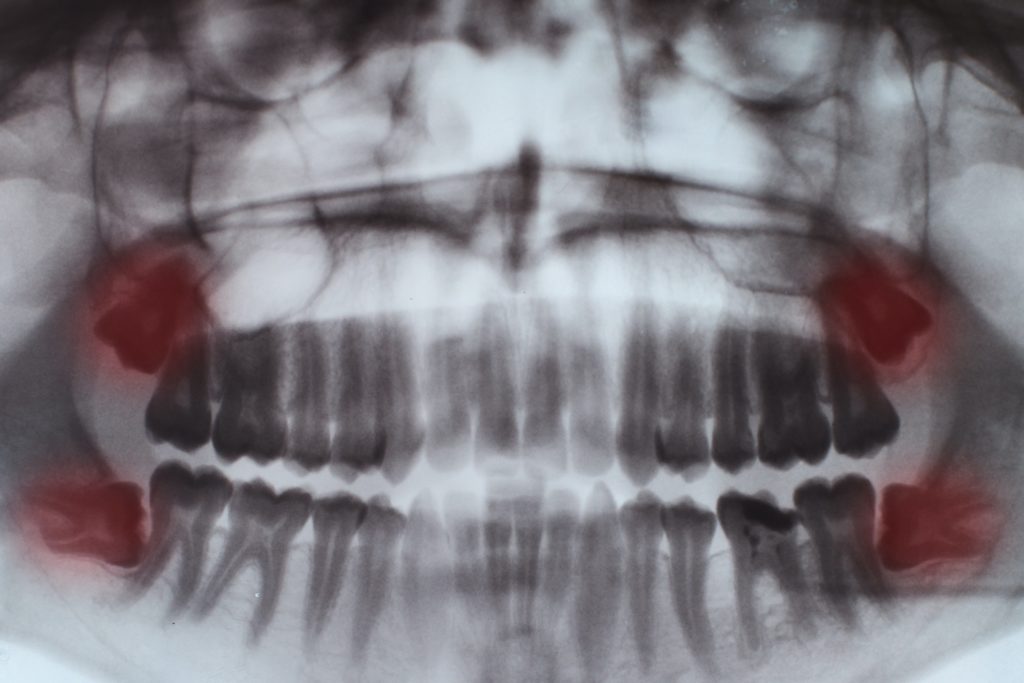 Teeth full X-ray